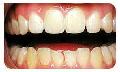Teeth Bonding and White Fillings