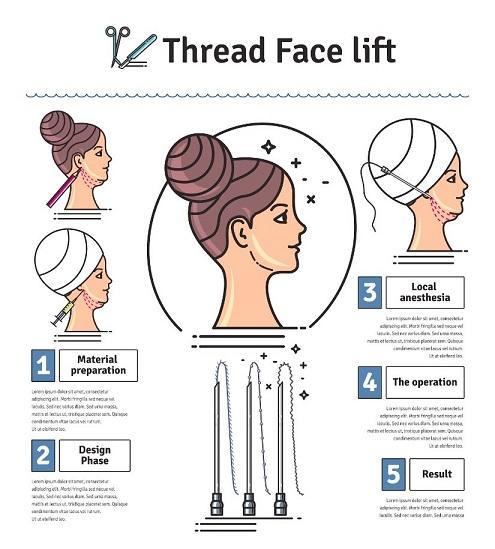 Thread Face Lift Procedure