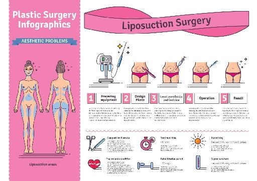 Plastic Surgery Infographics: Liposuction Surgery