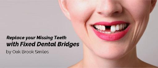 Replace your Missing Teeth with Fixed Dental Bridges by Oak Brook Smiles